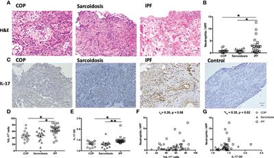 Increased Interleukin-17 and Glucocorticoid Receptor-β Expression in Interstitial Lung Diseases and Corticosteroid Insensitivity